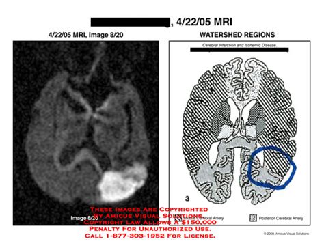 AMICUS Illustration Of Amicus Radiology Brain Mri Watershed Regions