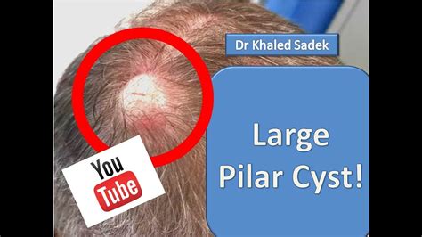Massive Pilar Cyst Removal Dr Khaled Sadek Lipomacyst Com Youtube