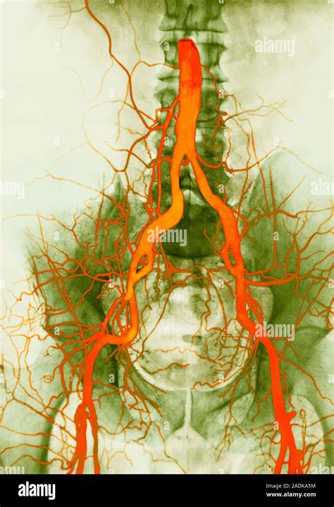 Abdominal Arteries Coloured Angiogram Of Healthy Iliac Arteries The
