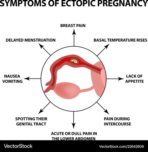 Symptoms Of Ectopic Pregnancy Infographics Vector Image