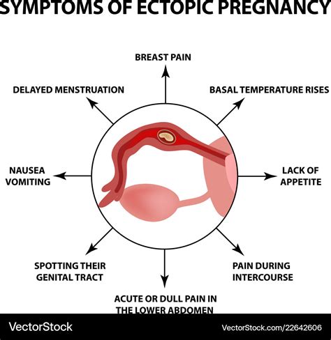 Symptoms Of Ectopic Pregnancy Infographics Vector Image
