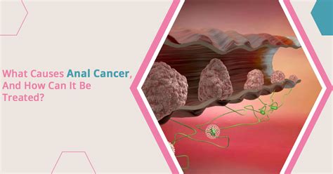Anal Cancer Causes And Treatment University Cancer Centers