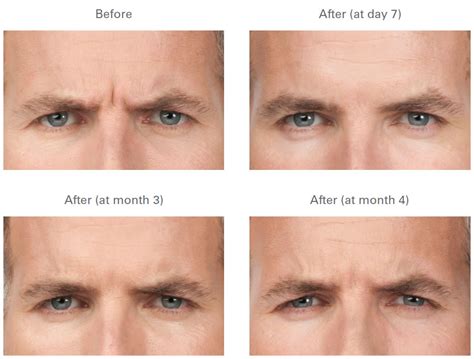 Botox Frown Lines Before And After Galleries Long Beach