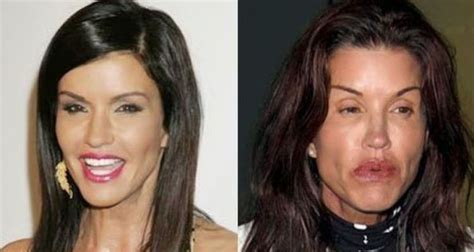 But her current lips look much better than before. Ruined Janice Dickinson Before and After Lip Injections ...
