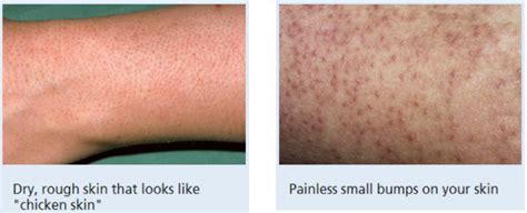 Keratosis Pilaris Treatment In Our Clinic Book A Consultation