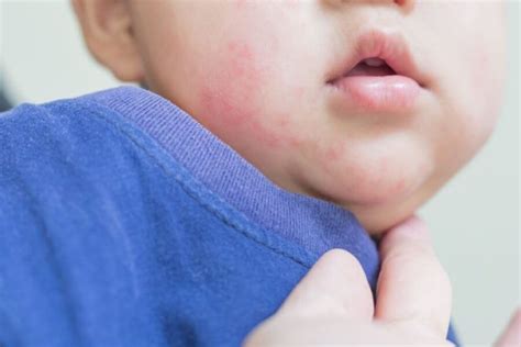 How Do I Know If My Baby Is Allergic To A Food Nabta Health