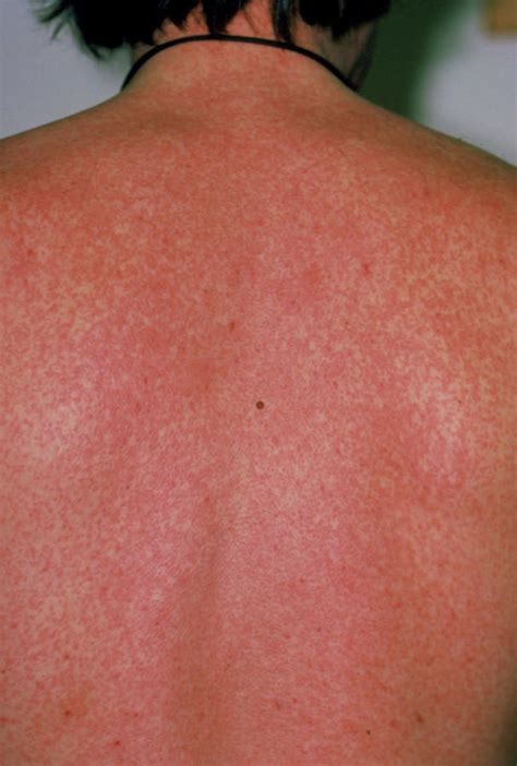 A Severe Measles Rash On The Back Of A Man Photograph By Dr P Marazzi