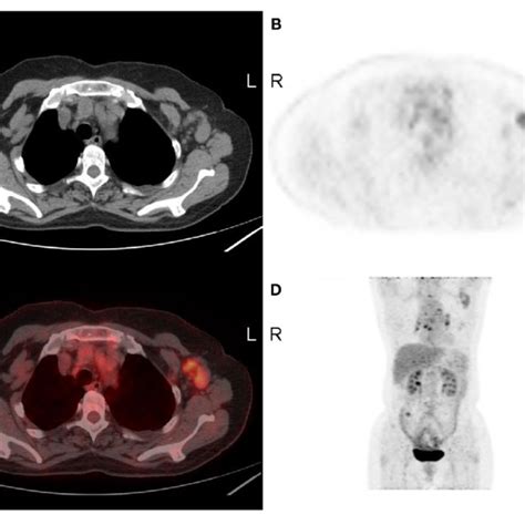 A 66 Year Old Woman With Lymph Node Metastasis Of The Left Breast