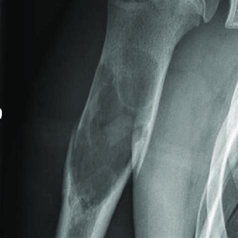 135 Years Old Boy With Second Pathological Fracture Radiographs Ap