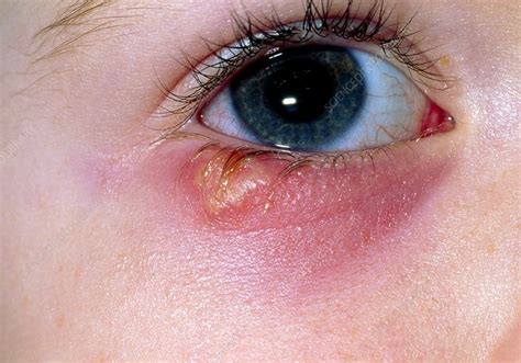 Herpes Simplex Blister Below Eye Of Young Girl Stock Image M170