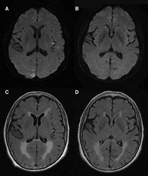 Early Magnetic Resonance Imaging In Transient Ischemic Attack And Minor