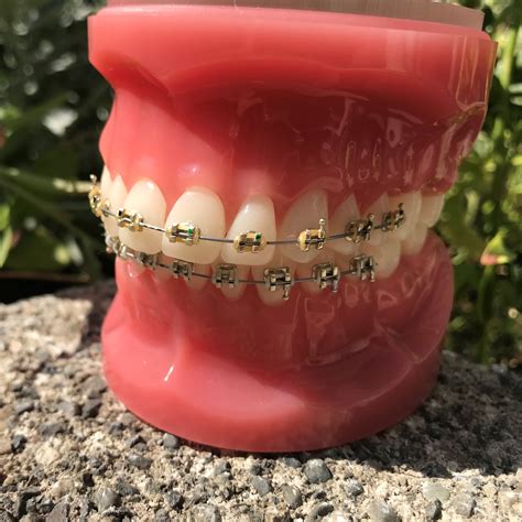 North Shore Orthodontics Braces