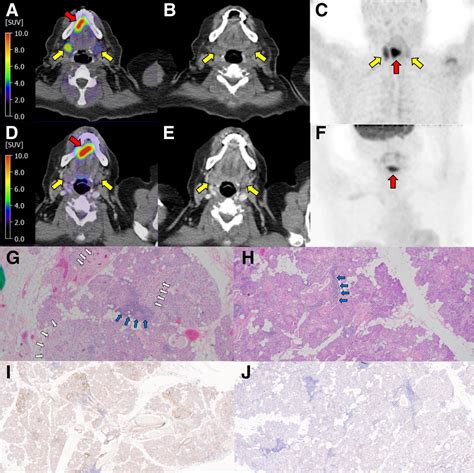 Obstructive Sialadenitis From Oral Squamous Cell Carcinoma 68ga Ga