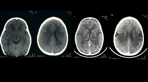 Meningitis And Encephalitis Differences Symptioms And Causes