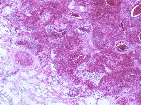 Acute Hemorrhagic Infarct Atlas Of Pulmonary Pathology Flickr