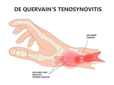 Condition Spotlight De Quervains Tenosynovitis By Amy Eckert