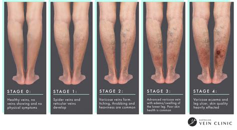 Sclerotherapy Varicose Vein Removal Melbourne