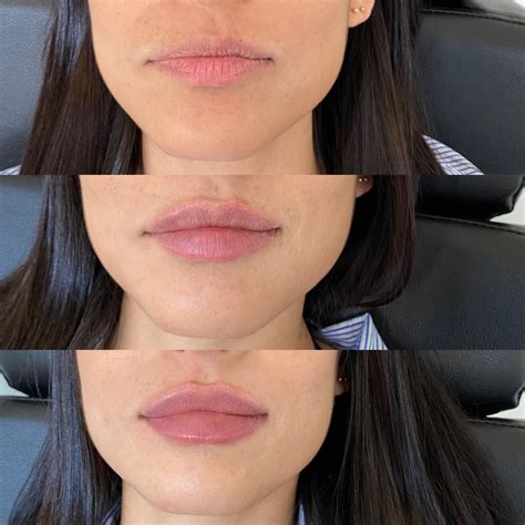 Half Or Full Syringe When It Comes To Lips Which Is Best — Danielle