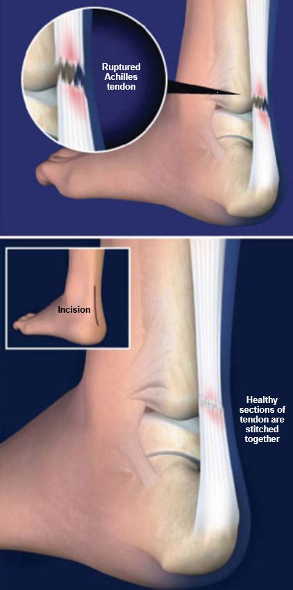 Surgery For Achilles Tendon Rupture Central Coast Orthopedic Medical