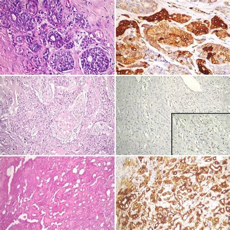 Salivary Gland Tumors Classification According To Presence Or Absence