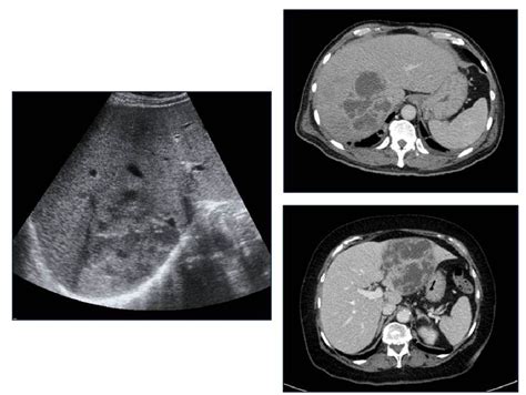 Figure 6 From Differential Diagnosis Of Complex Liver Cysts Semantic