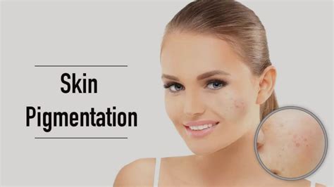 Common Reasons For Pigmentation On Face