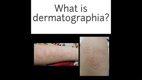 Dermatographia Skin Writing Youtube