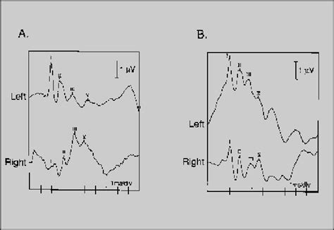 A 1b Brain Stem Auditory Evoked Response Baer Test Recordings