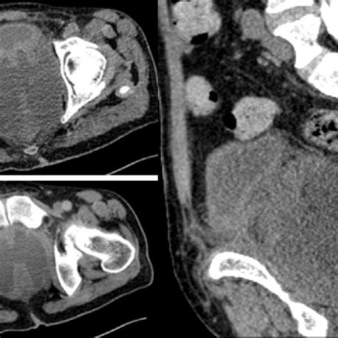 Abdominal And Pelvic Ct Scan In Axial Section Without Enhancement A