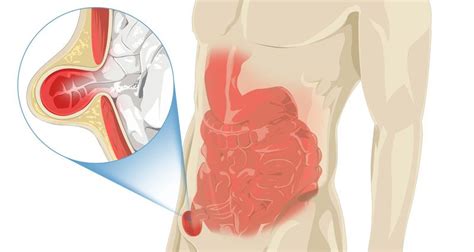 Inguinal Hernia Symptoms Causes And Treatment