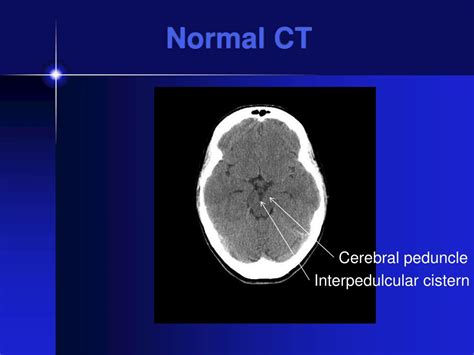 Ppt Ct Scans Of The Head A Neurologists Perspective Powerpoint