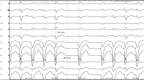 Pleomorphic Wide Complex Tachycardia Heart Rhythm