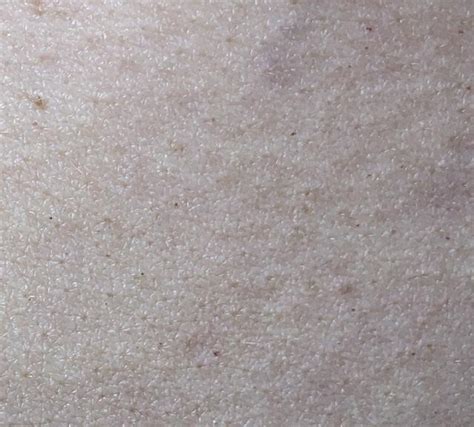 Tiny Red Dots I Recently Started Noticing Tons Of My Skin