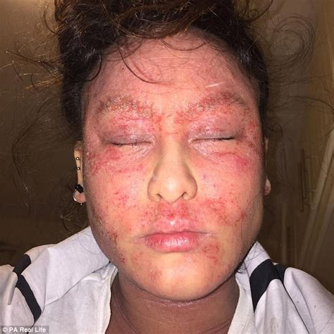 Eczema Sufferer Has To Vacuum Her Bed Every Day Daily Mail Online