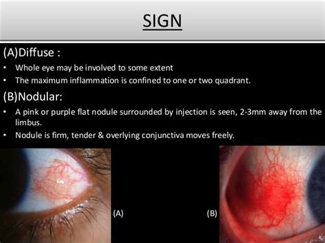 Episcleritis And Scleritis Ophthalmology