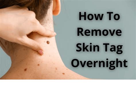 how to remove skin tag overnight