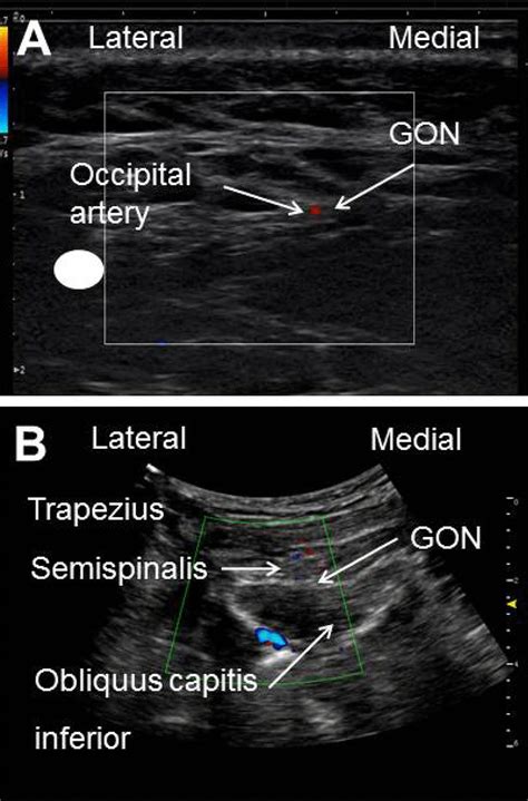 Ultrasound Guided Greater Occipital Nerve Gon Block Panel A The