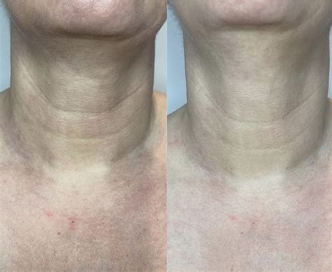 Co2 Laser Resurfacing The Norwich Face And Body Clinic