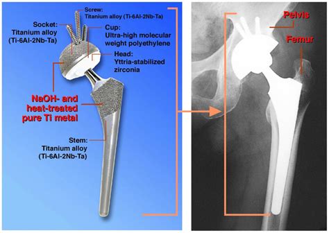 Artificial Hip Joint Porous Ti Metal Layer Of Which Was Heat Treated