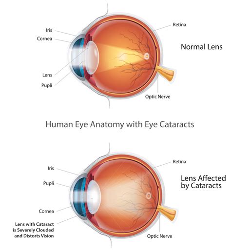 Cataract Azar Eye Clinic