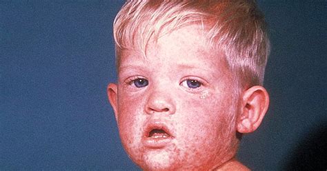 What Does Measles Look Like Measles 7 Things Parents