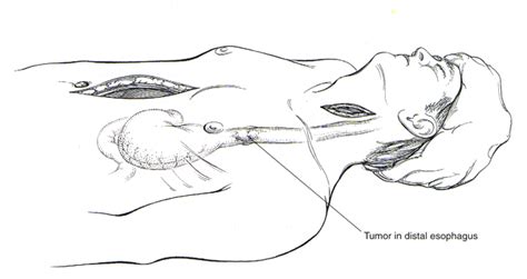 An esophagectomy is a surgery to remove part or all of the esophagus (the tube through which food. Transhiatal Esophagectomy | CTSNet