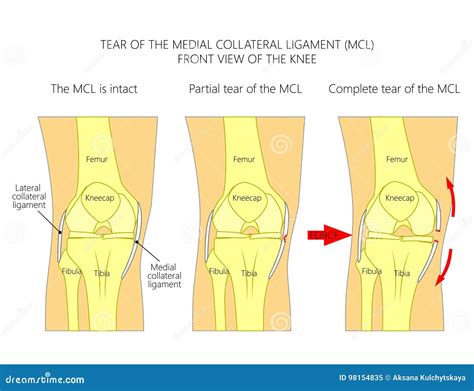 Ligaments Du Kneetear Du Ligament Collatéral Médial Illustration De