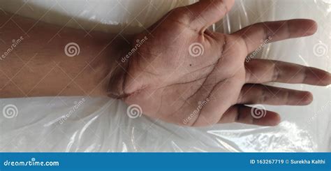 Scar On A Hand After Injury Stock Image Image Of Hand Injury 163267719