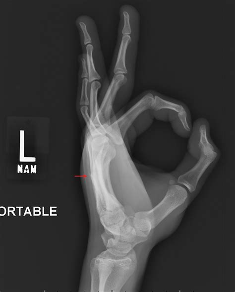 Punchin Out Fifth Metacarpal Boxers Fracture Radiology Key