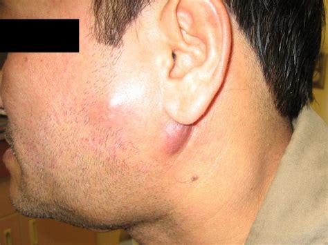 Swollen Lymph Nodes Symptoms Causes And Complications