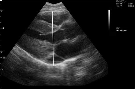 Ultrasound Scan Of A Heart From The Anterior Fibrous Pericardium To The