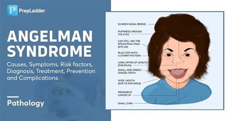 Angelman Syndrome Causes Symptoms Risk Factors Diagnosis Treatment