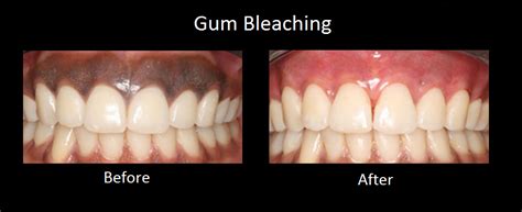 The concentration of hydrogen peroxide used for lightening the hair is much stronger than the solution used to disinfect and treat wounds. Gum bleaching | News | Dentagama