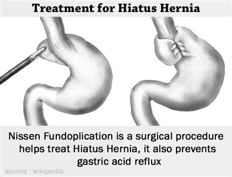 Hiatus Hernia Types Causes Symptoms Complications Diagnosis